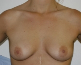 Feel Beautiful - Breast Augmentation 34a - Before Photo